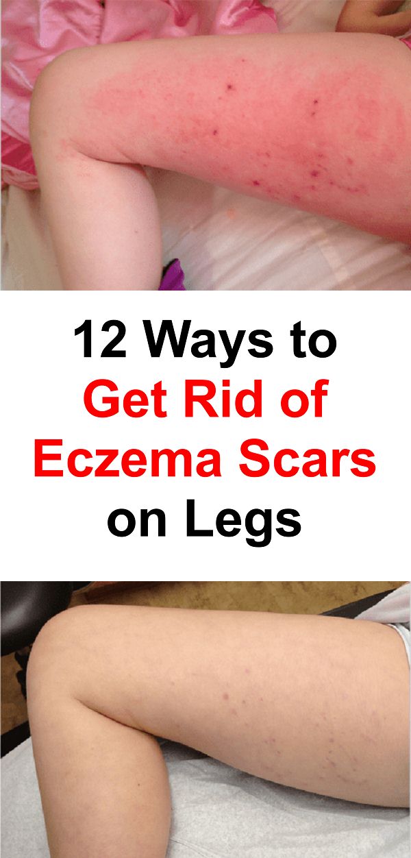 12-ways-to-get-rid-of-eczema-scars-on-legs-body